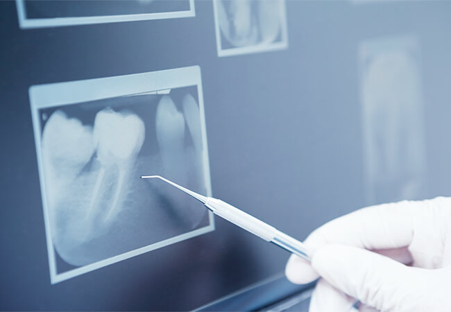 歯周病のスクリーニング