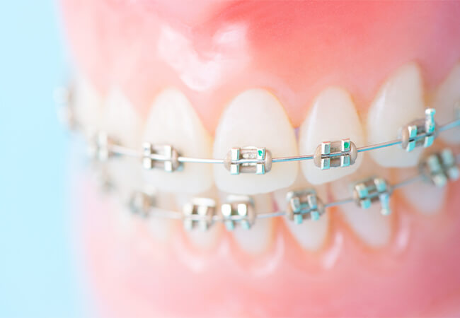歯並びの治療（歯の矯正）